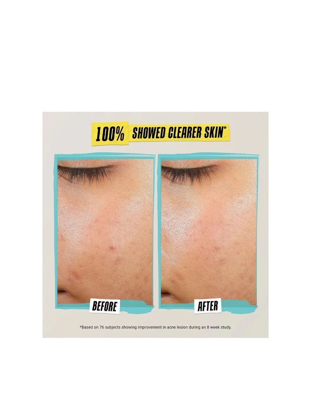 Kiehl's Expertly Clear Acne-Treating & Preventing Lotion $39
